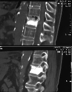 Pooperačné CT snímek vyplněného obratle