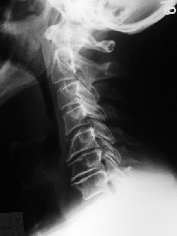Předoperační boční snímek pacienta