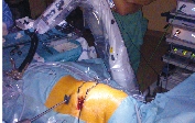 Pohled na pacienta před instalací kamery na robotické rameno, umístění pracovní incize