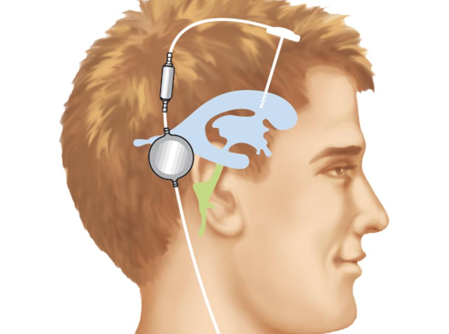 Normotenzní hydrocefalus - složitá diagnostika, jednoduchá léčba