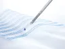 Fixace síťky u laparoskopické operace tříselné kýly pomocí lepidla Histoacryl® Pro Set MFX 