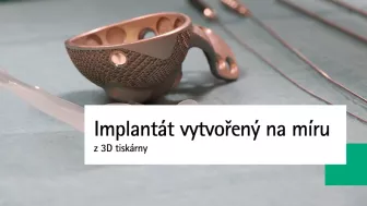 Implantát vytvořený na míru z 3D tiskárny