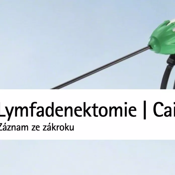Rozšířená ilio-obturatis lymfadenektomie