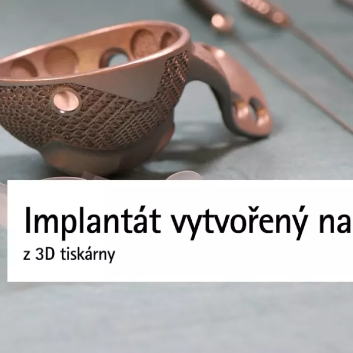 Implantát vytvořený na míru z 3D tiskárny